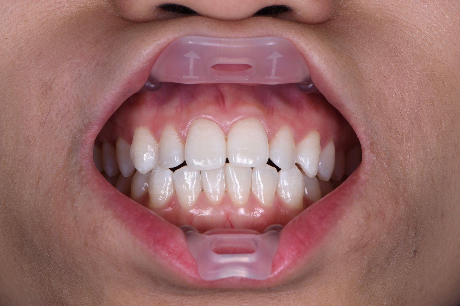 A striking experience Dental treatments made easy with Umbrella™ the new tongue, lip, and